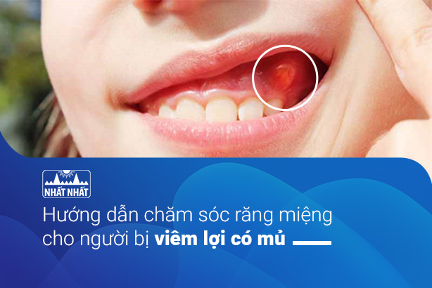Hướng dẫn chăm sóc răng miệng cho người bị viêm lợi có mủ