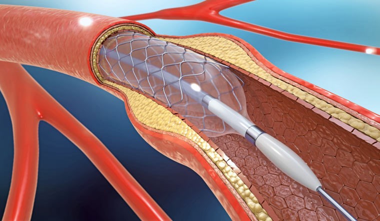 Hình ảnh stent mạch vành
