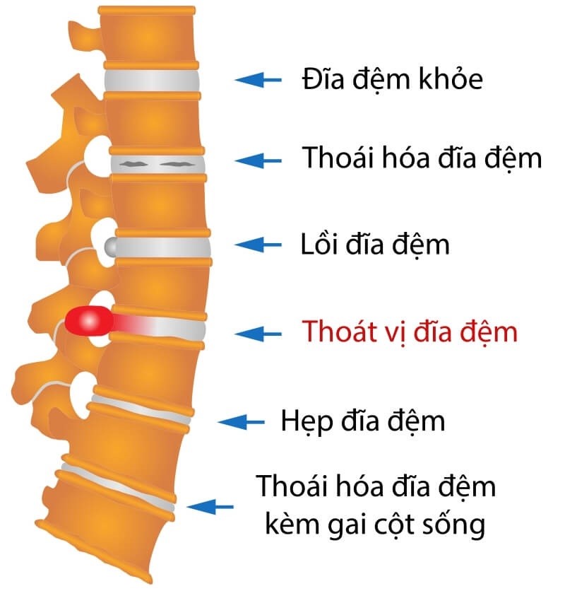 đau lưng là dấu hiệu bệnh gì