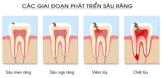 sâu răng hàm có lỗ nên làm gì