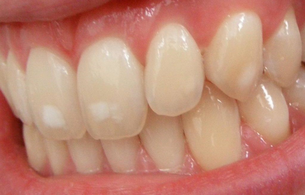  Sâu răng nhẹ 