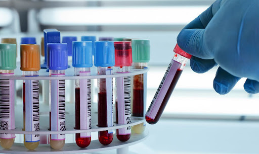 Tổng phân tích tế bào máu ngoại vi giúp chẩn đoán bệnh hồng cầu hình liểm