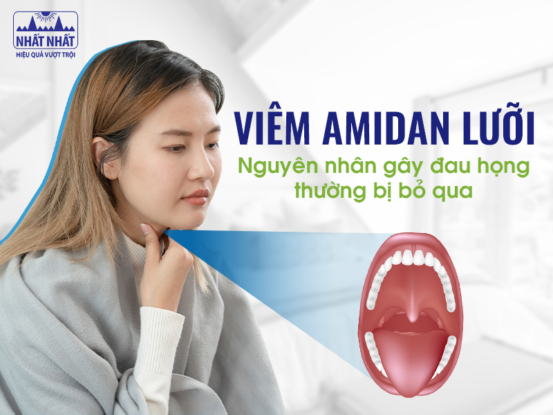 Viêm amidan lưỡi là một nguyên nhân hiếm gặp gây viêm họng