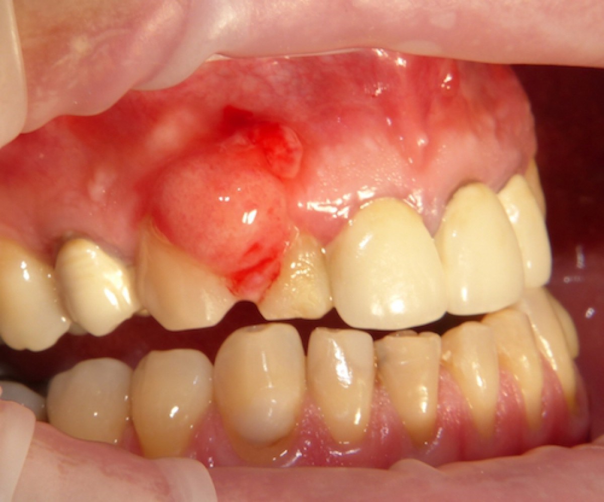 Viêm chân răng hàm có mủ 