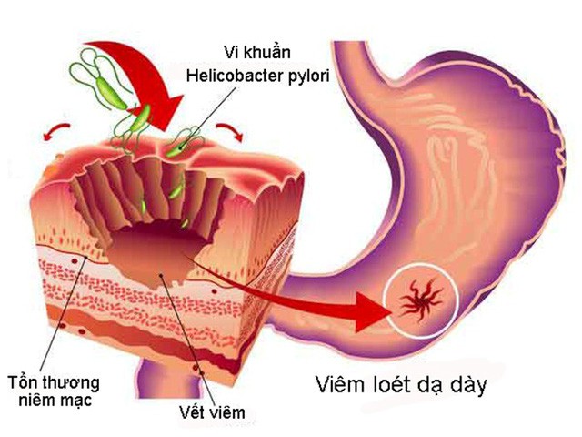 viêm dạ dày hp