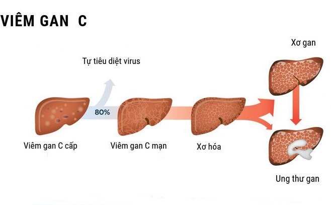 Bệnh viêm gan C