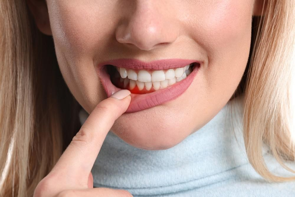 Những nguy hiểm tiềm ẩn khi bị chảy máu chân răng liên tục
