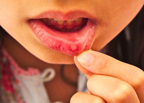 Giai đoạn đầu của nhiệt miệng chỉ là những điểm nhỏ hơi đau trong niêm mạc miệng
