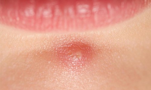 Mụn ẩn dễ xảy ra ở vùng chữ T trên mặt – nơi tiết ra nhiều dầu nhờn