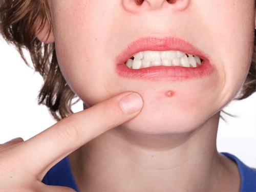Mụn trứng cá thường có nhân màu trắng và xung quanh sưng đỏ