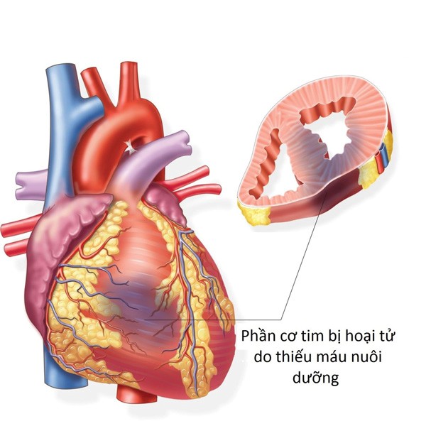 Hoạt tử cơ tim do nhồi máu cơ tim có thể dẫn tới sẹo tim