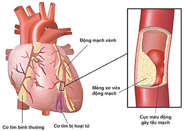 Vữa xơ động mạch vành gây tắc, dẫn đến nhồi máu cơ tim