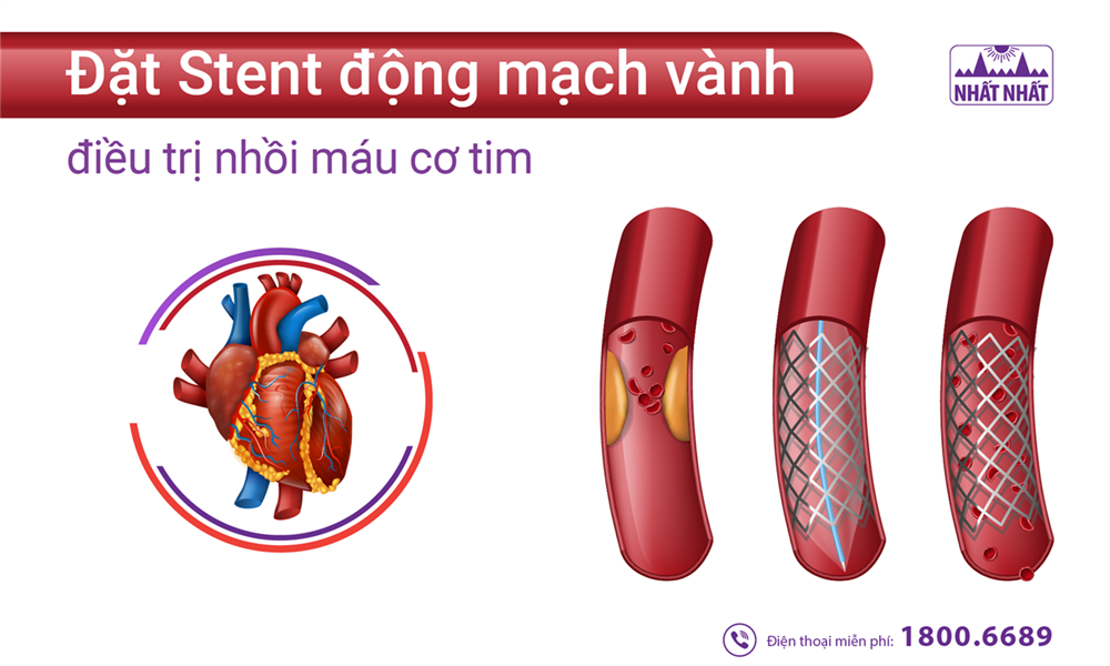 Đặt Stent động mạch vành điều trị nhồi máu cơ tim