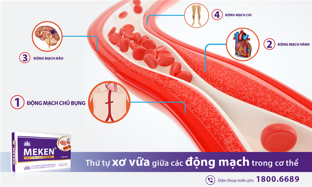 MẠCH MÁU NÀO DỄ BỊ XƠ VỮA ĐỘNG MẠCH NHẤT?