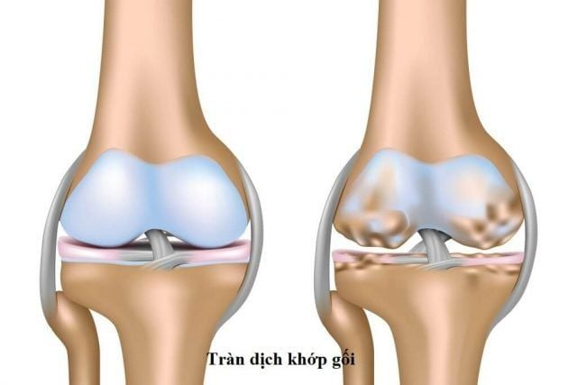 Viêm khớp gối có dịch: Những biến chứng không thể lơ là!