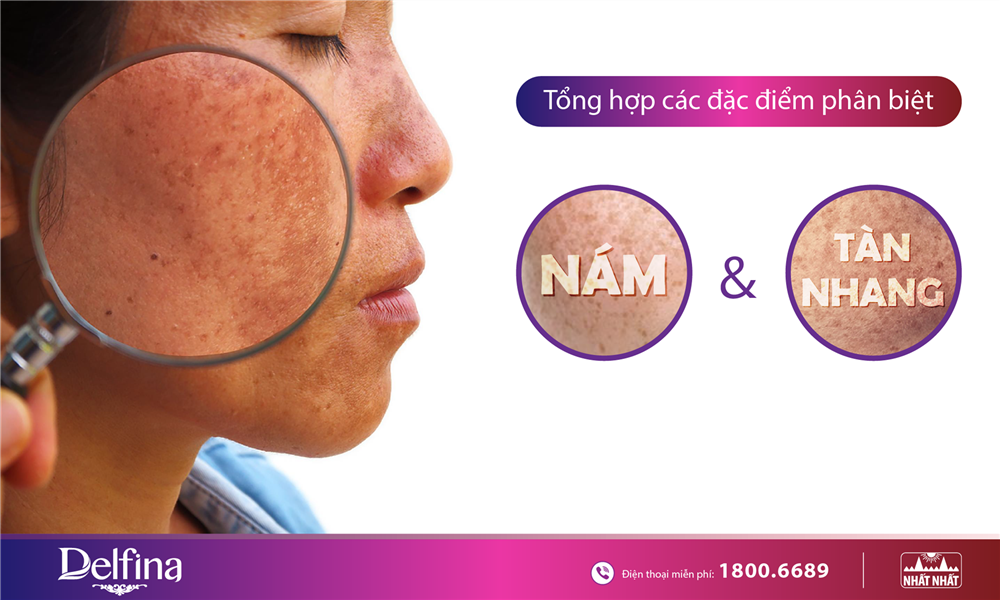 5 Điểm phân biệt rõ rệt giữa da bị nám và tàn nhang