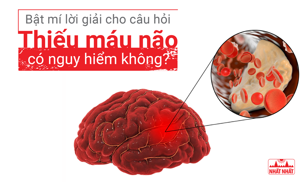 Bật mí lời giải cho câu hỏi “Thiếu máu não có nguy hiểm không?”