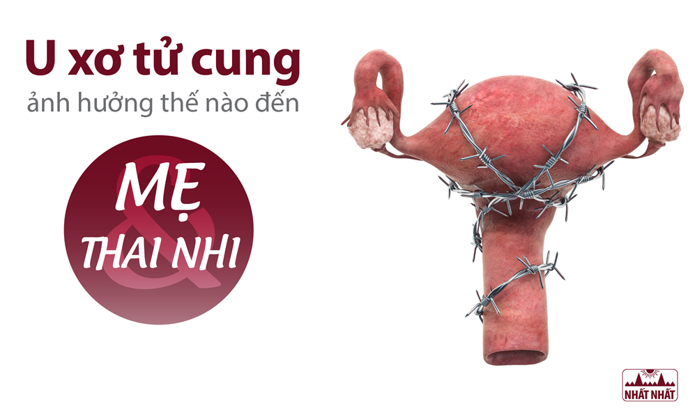 U xơ tử cung ảnh hưởng thế nào đến mẹ và thai nhi