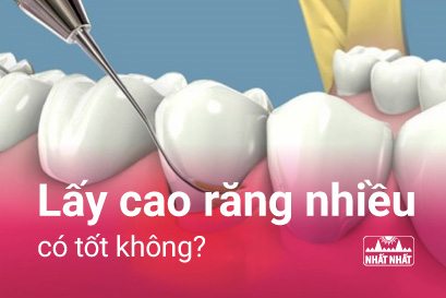 Lấy cao răng nhiều có tốt không và cách chăm sóc răng miệng sau khi lấy cao răng