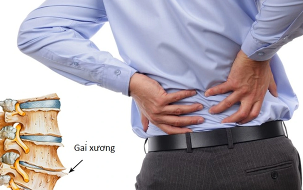 Bệnh gai cột sống thắt lưng – Giải pháp điều trị ít người biết!