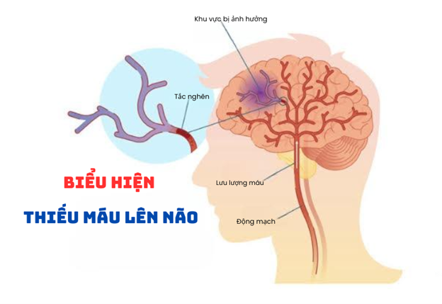 Biểu hiện của thiếu máu lên não: Đừng bỏ qua!