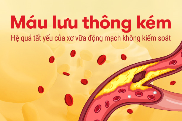 Máu lưu thông kém - Hệ quả tất yếu của xơ vữa động mạch không kiểm soát