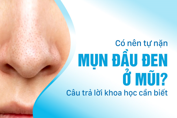 Có nên tự nặn mụn đầu đen ở mũi: Câu trả lời khoa học cần biết