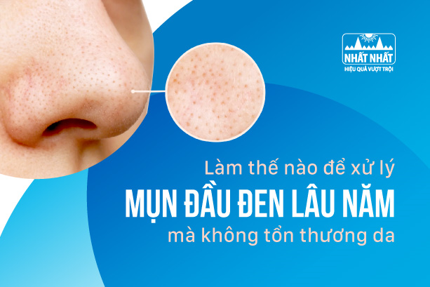 Làm thế nào để xử lý mụn đầu đen lâu năm mà không tổn thương da