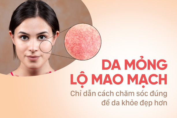 Da mỏng lộ mao mạch: Chỉ dẫn cách chăm sóc đúng để da khỏe đẹp hơn