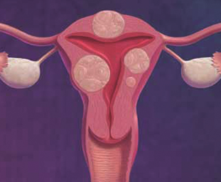 Dạng viên nén tiện dụng, bài thuốc tiêu u Đông y thế hệ 2
ĐẶC TRỊ U XƠ TỬ CUNG, U VÚ LÀNH TÍNH