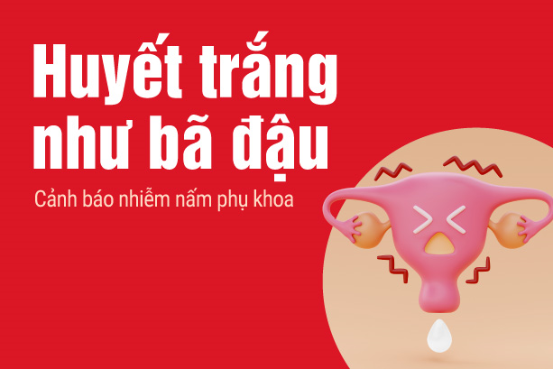 Huyết trắng vón cục như bã đậu: Cảnh báo nhiễm nấm phụ khoa