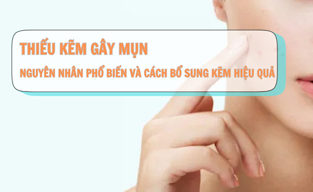 Thiếu kẽm gây mụn: Nguyên nhân phổ biến và cách bổ sung kẽm hiệu quả