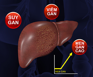Bài thuốc giải độc gan Đông y thế hệ 2 kỳ diệu ĐẶC TRỊ VIÊM GAN, MEN GAN CAO, ĐẦY BỤNG, CHÁN ĂN, MỀ ĐAY, NÓNG GAN, MỤN