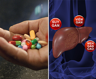 THUỐC ĐÔNG Y THẾ HỆ 2 GIẢI ĐỘC GAN, TRỊ VIÊM GAN DO DÙNG NHIỀU THUỐC TÂY