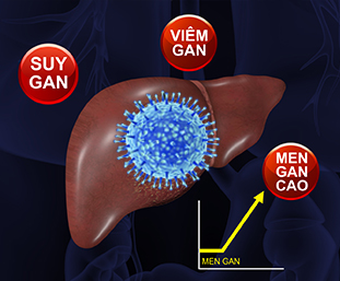 THUỐC ĐÔNG Y THẾ HỆ 2 HỖ TRỢ ĐIỀU TRỊ HIỆU QUẢ VIÊM GAN B
