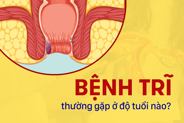 Giải đáp: Bệnh trĩ thường gặp ở độ tuổi nào?