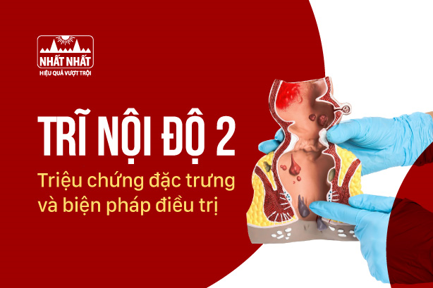 Trĩ nội độ 2: Triệu chứng đặc trưng và biện pháp điều trị 