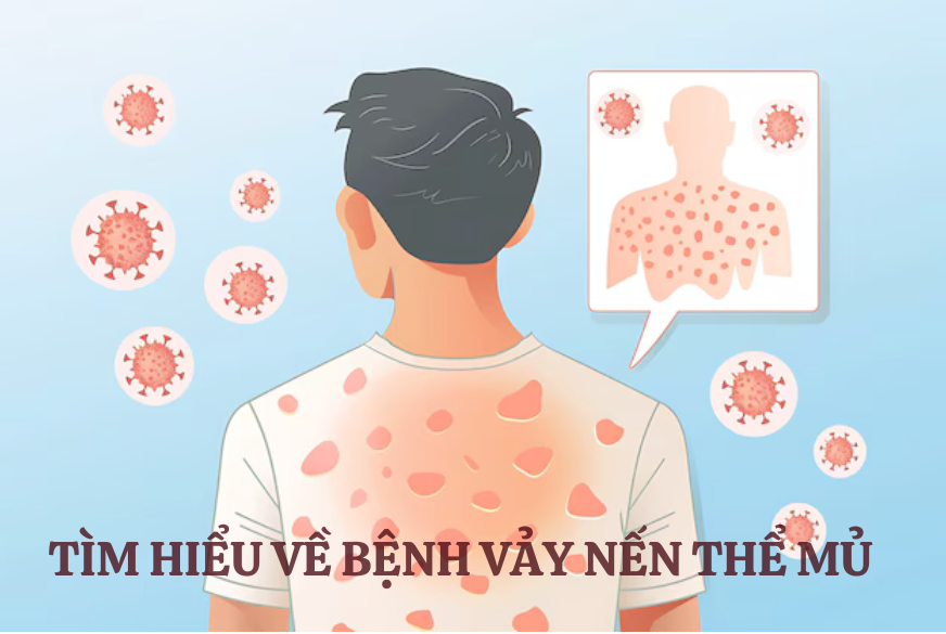 Vảy nến thể mủ: Cách điều trị và ngăn ngừa sẹo hiệu quả cao