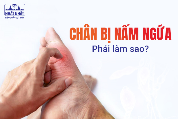 Giải đáp nhanh thắc mắc: Chân bị nấm ngứa phải làm sao?