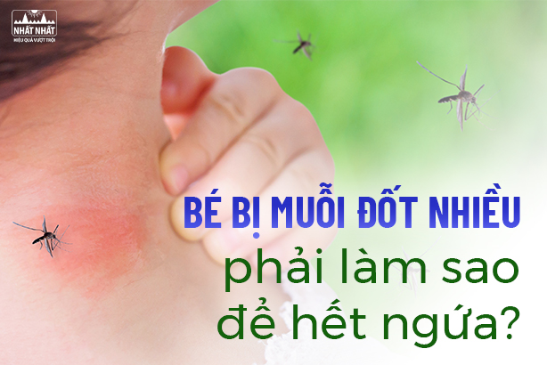 Bé bị muỗi đốt nhiều phải làm sao để hết ngứa?