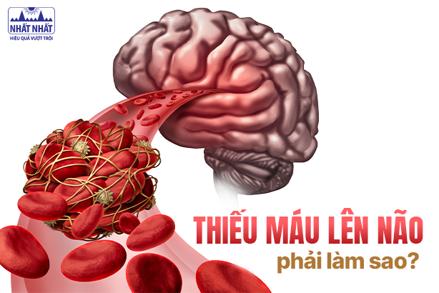 Giải đáp ngay: Thiếu máu lên não phải làm sao?