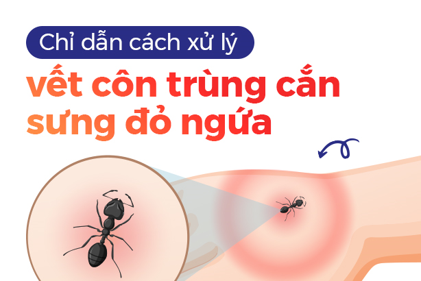 Chỉ dẫn cách xử lý vết côn trùng cắn sưng đỏ ngứa