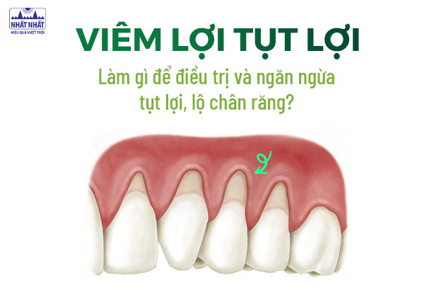 Viêm lợi tụt lợi: Làm gì để điều trị và ngăn ngừa tụt lợi, lộ chân răng?