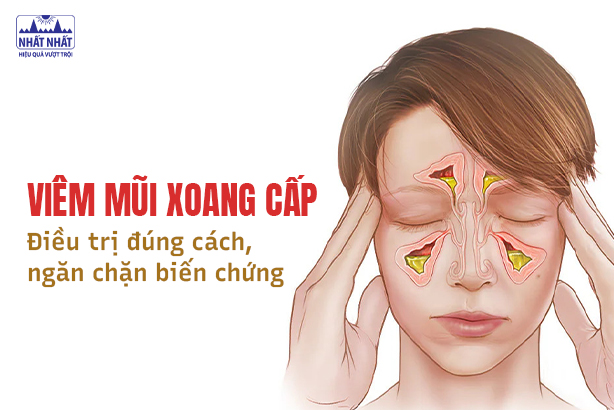 Viêm mũi xoang cấp: Điều trị đúng cách, ngăn chặn biến chứng