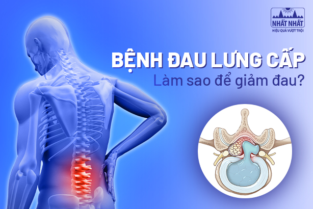 Bệnh đau lưng cấp: Làm sao để giảm nhanh cơn đau dữ dội?