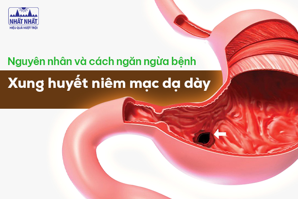 Tìm hiểu nguyên nhân và cách ngăn ngừa bệnh xung huyết niêm mạc dạ dày
