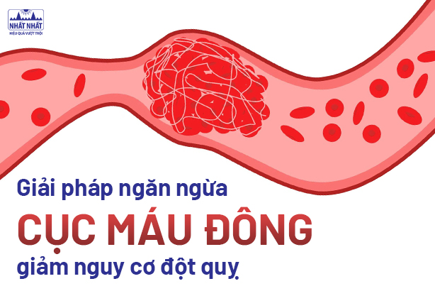 Áp dụng ngay giải pháp ngăn ngừa cục máu đông, giảm nguy cơ đột quỵ