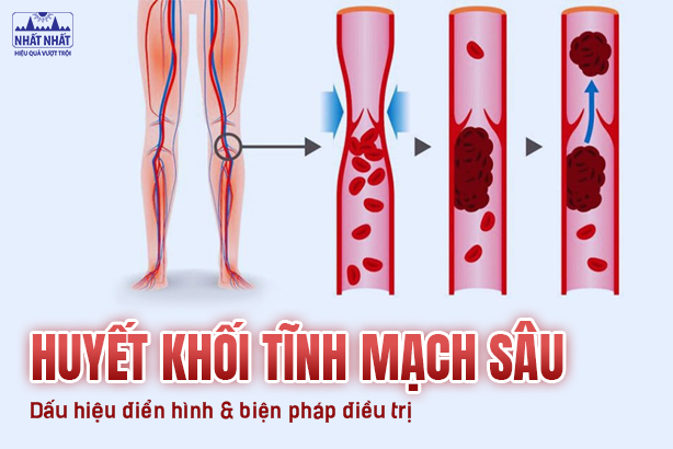 Huyết khối tĩnh mạch sâu: Các dấu hiệu điển hình và biện pháp điều trị hiệu quả