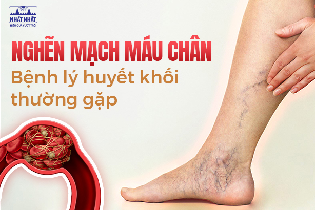 Nghẽn mạch máu chân: Bệnh lý huyết khối thường gặp