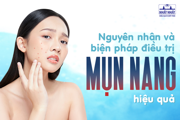 Nguyên nhân và các biện pháp điều trị mụn nang hiệu quả